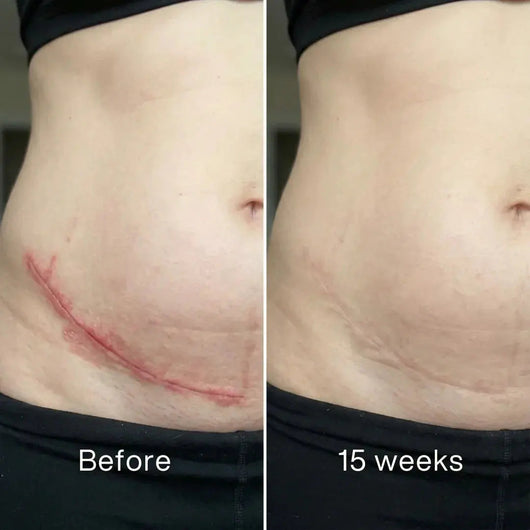 Pluune scar treatment before and after 15 weeks on lower abdomen, visible scar fading results
