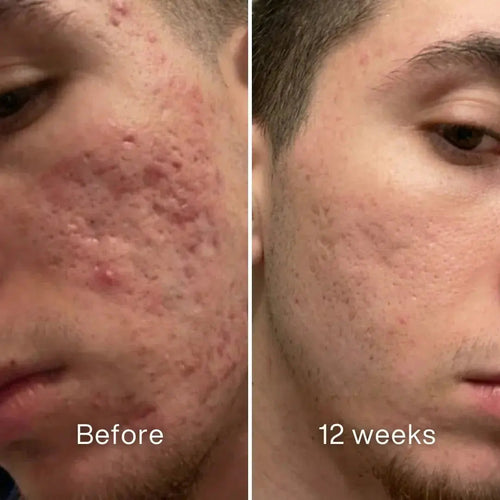 Clinical Acne Scar Remodeling Stick™.