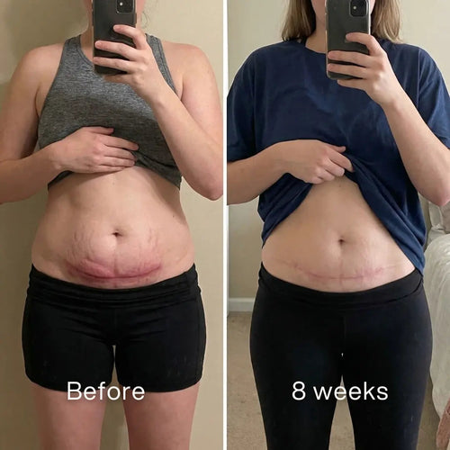 Clinical C-Section Scar Remodeling Stick™