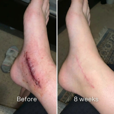 Surgical Scar Remodeling Stick™ Pluune
