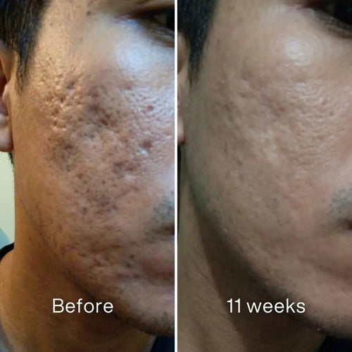 Acne Scar Invisible Repair Barrier™