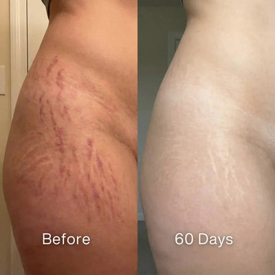 Pluune stretch mark cream before and after 60 days result on hip skin