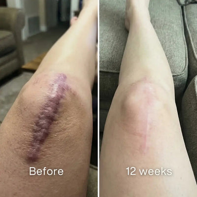 Surgical Scar Remodeling Stick™ Pluune
