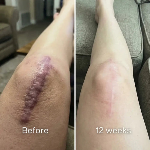 Self-Harm Scar Remodelling Stick™