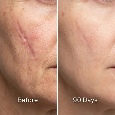 Before and after 90 days facial scar improvement with Pluune skincare