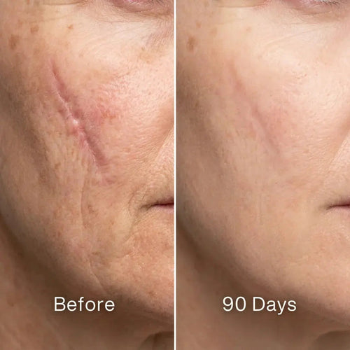 Scar Renewal - Advanced Medical Silicone