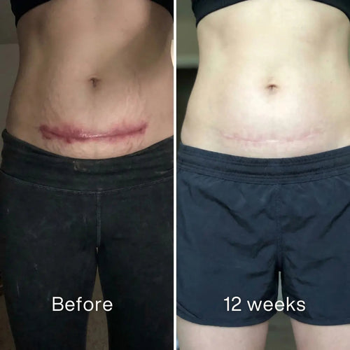 Surgical Scar Remodeling Stick™