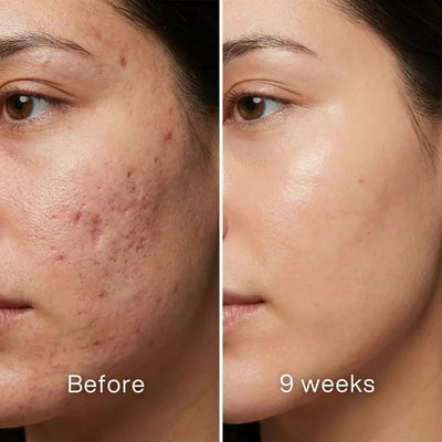 Pluune skincare before and after results, showing reduced acne scars and smoother skin in 9 weeks