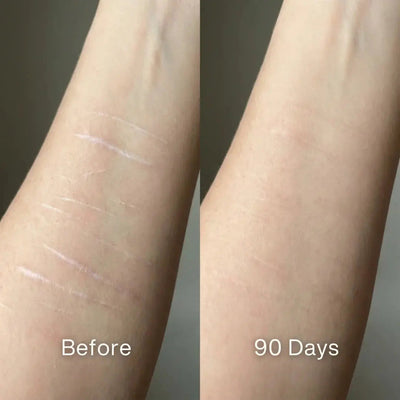 Pluune scar treatment before and after 90 days result on forearm skin